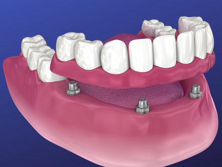 https://www.gm-dental.co.uk/wp-content/uploads/2022/07/305c26_f451f2050697477189cf0c85602fd378_mv2.webp