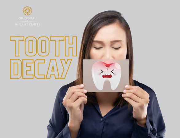 Tooth Decay - What It Causes -GM Dental And Implant Centre